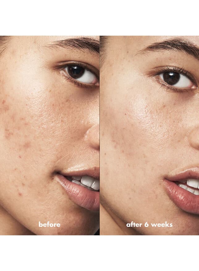 ELF BLEMISH BREAKTHROUGH TRIPLE-ACID RESURFACING SERUM 2