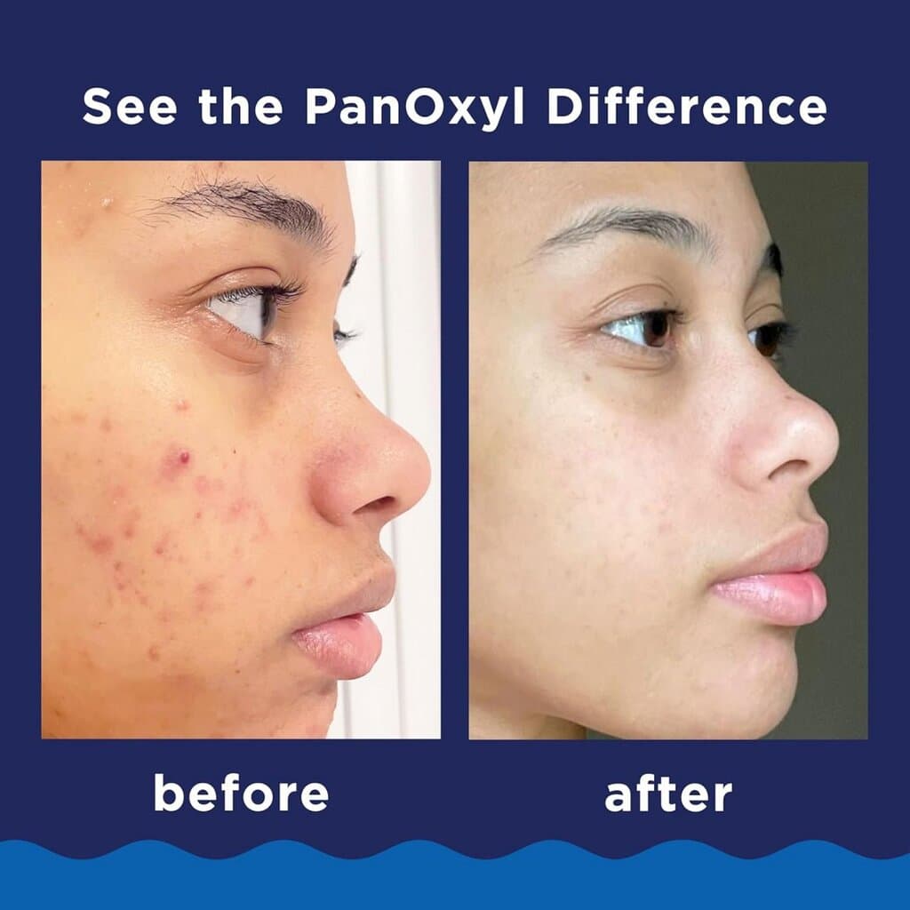 PanOxyl Creamy Acne Wash 4% Benzoyl peroxide 2