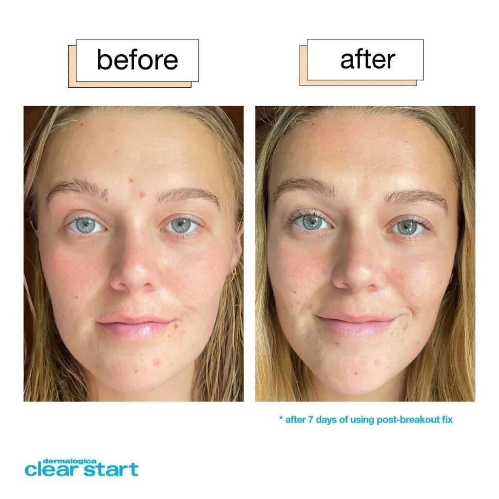 Dermalogica Clear Start Post-Breakout Fix, Acne Dark Spot Treatment 2