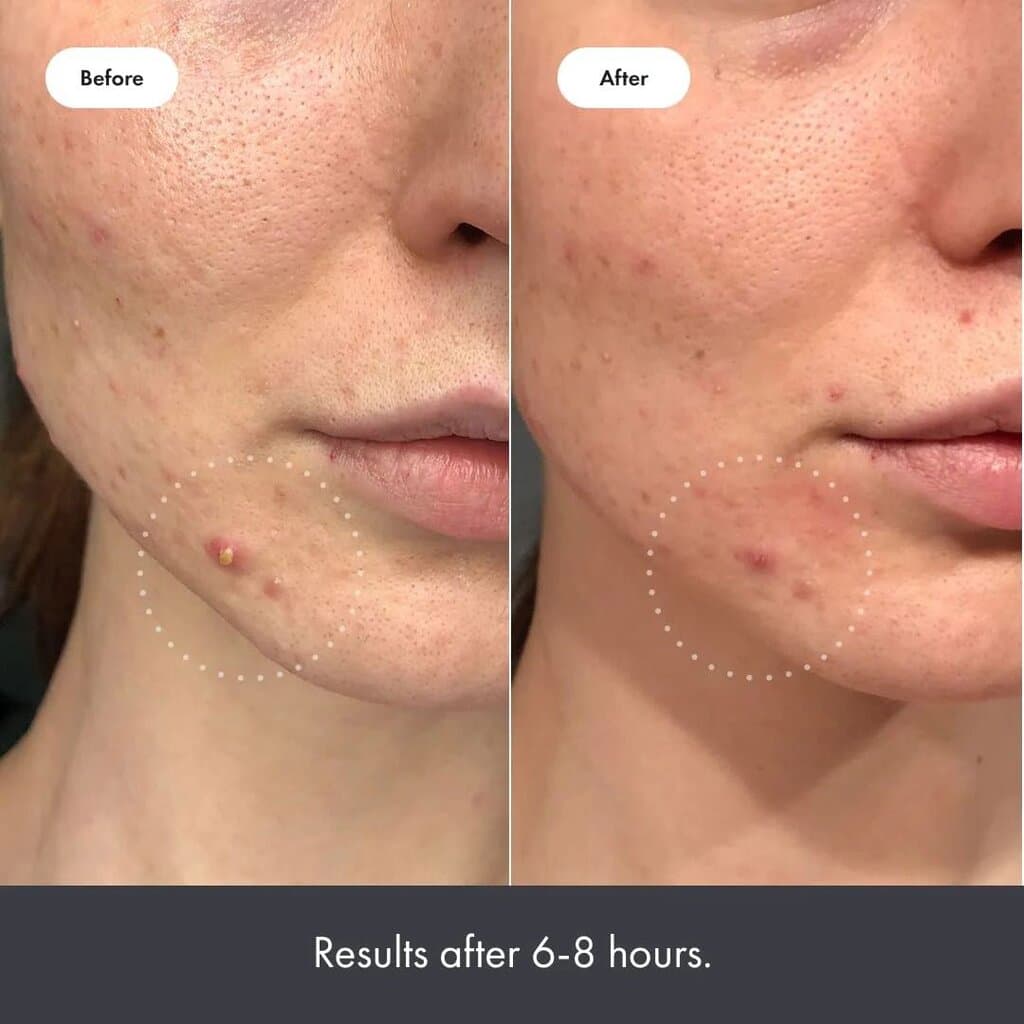 Hero Cosmetics Mighty Patch by Hero Cosmetics Original Acne Pimple Patch/27pic 2