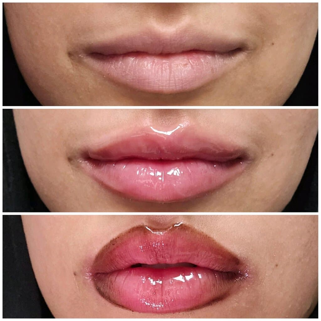 Sydney's Beauty - Lipfiller Plump (EXTREME) 3