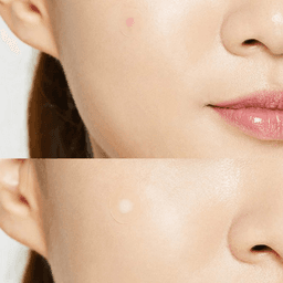 Cosrx Adhesive Bandages For Treating Acne — photo 2