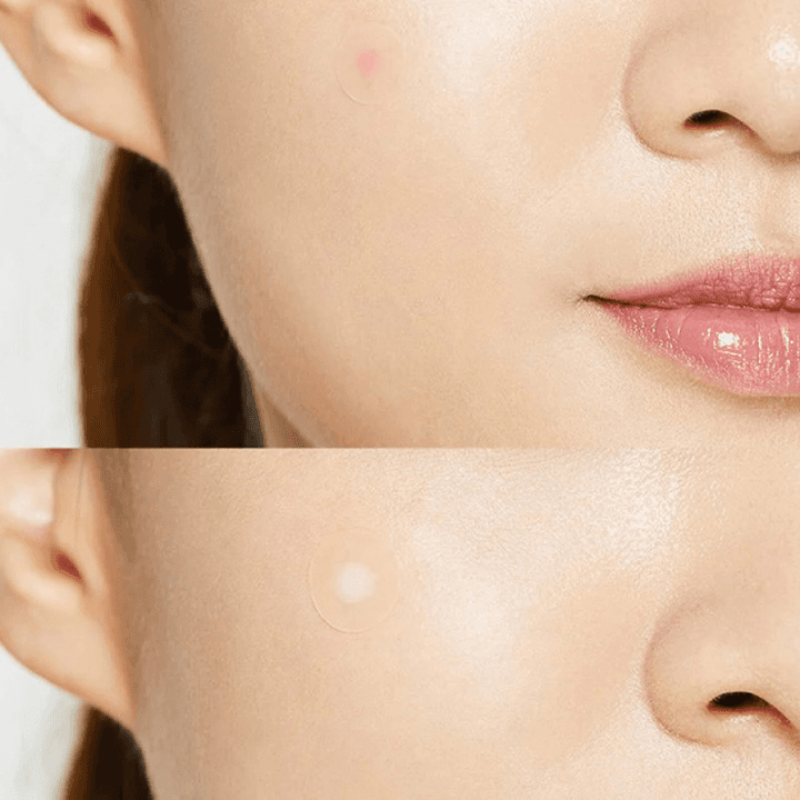 Cosrx Adhesive Bandages For Treating Acne — photo 2